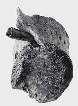 Боевое ранение: бронзовы наконечник стрелы в позвонке. Клингс, Южная Тюрингия (по: Osgord и. а. 2000)